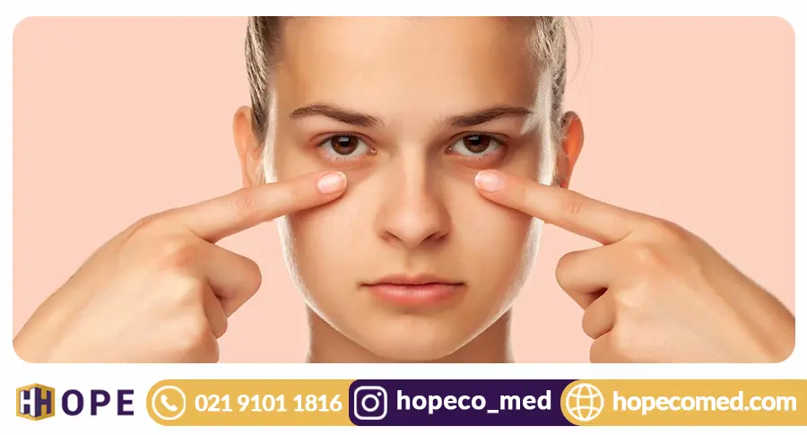 Q-Switch laser dark circles treatment